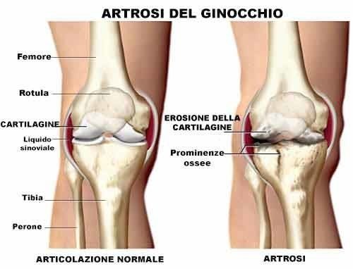 Artrosi ginocchio terapia